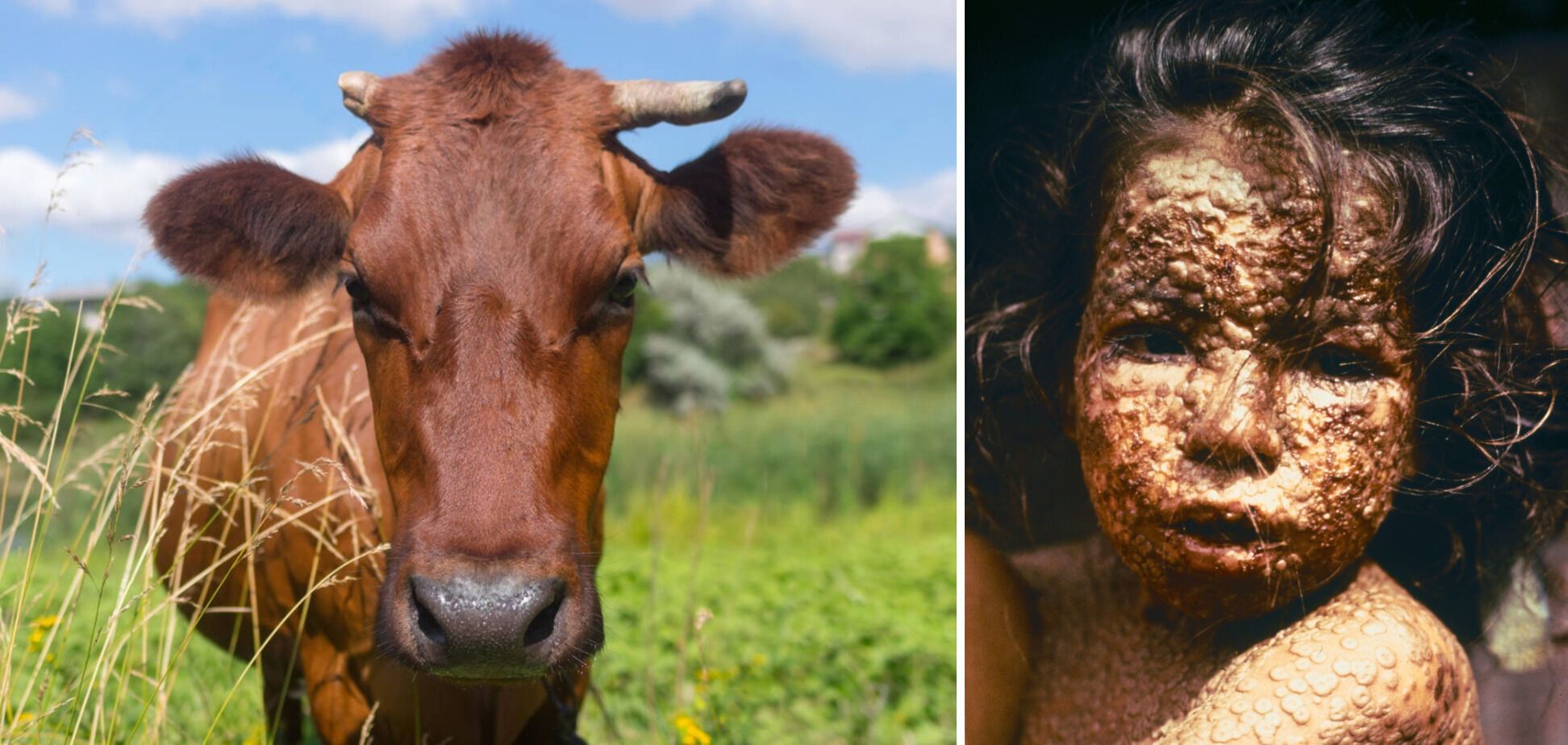 Протягом багатьох століть люди шукали ліки від віспи і зрештою знайшли – завдяки коровам